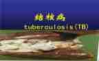 2024年结核病防治工作总结6篇
